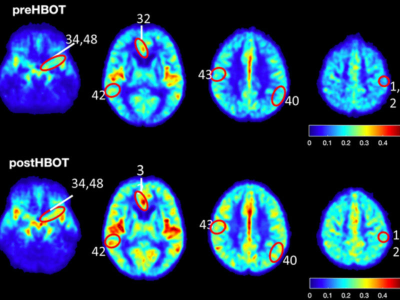 Figure 8. CBF and cognitive function are improved following HBOT of patients.