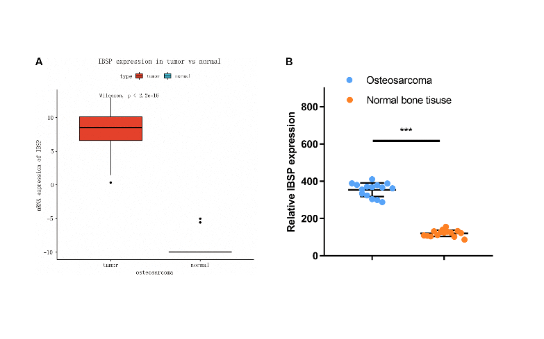 High expression of integrin-binding sialoprotein (IBSP) is associated with poor prognosis of osteosarcoma